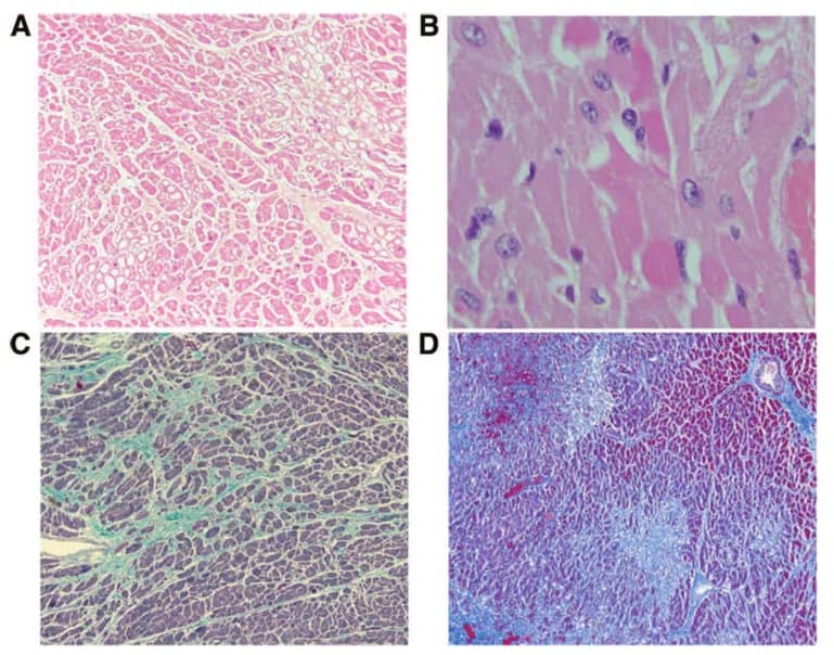 Tổn thương vi thể trên cơ tim của doxorubicin