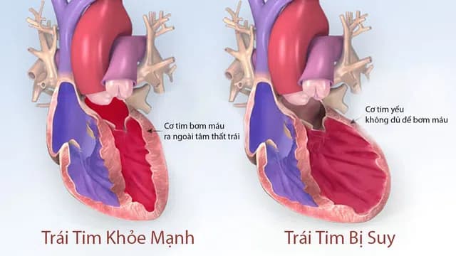 Suy tim là bệnh mạn tính, khó có thể chữa khỏi hoàn toàn và là biến chứng chung của tất cả những bệnh tim mạch