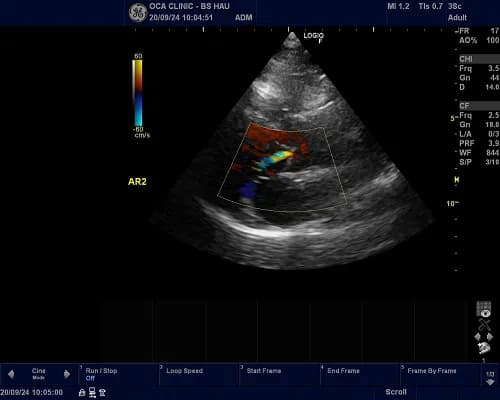 siêu âm doppler tim ở phòng khám bác sĩ Phạm Xuân Hậu