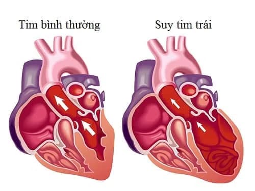 Suy tim là gì và cơ cơ chế điều hòa tim mạch như thế nào