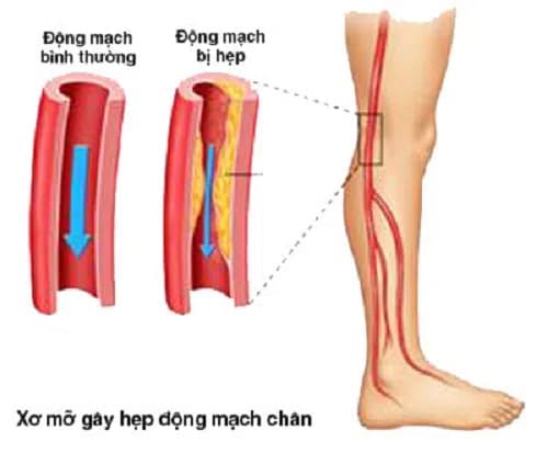 Bệnh xơ vữa động mạch chi dưới là gì?
