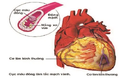 benh-thieu-mau-co-tim-co-nguy-hiem-khong-2