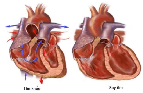 Biến chứng của suy tim rất nguy hiểm 