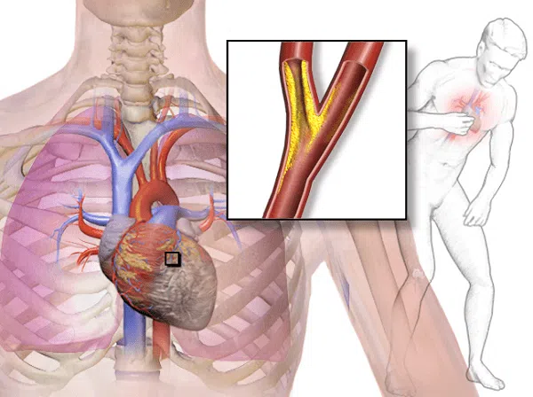 Phát hiện sớm bệnh mạch vành