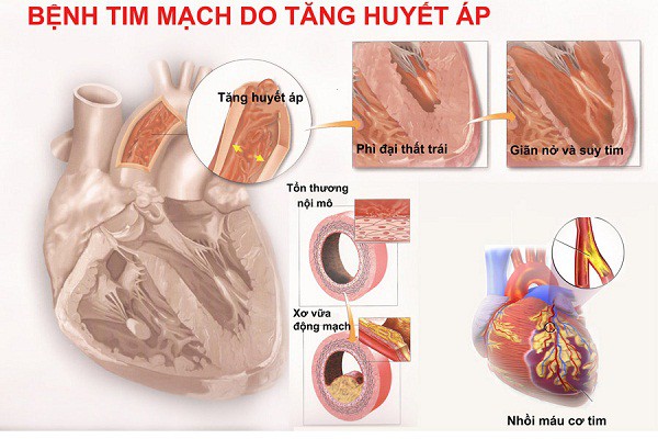 BS khuyến cáo: Người cao huyết áp tuyệt đối không làm điều này kẻo đột quỵ mất mạng có ngày - Ảnh 3. BS khuyến cáo: Người cao huyết áp tuyệt đối không làm điều này kẻo đột quỵ mất mạng có ngày - Ảnh 3.