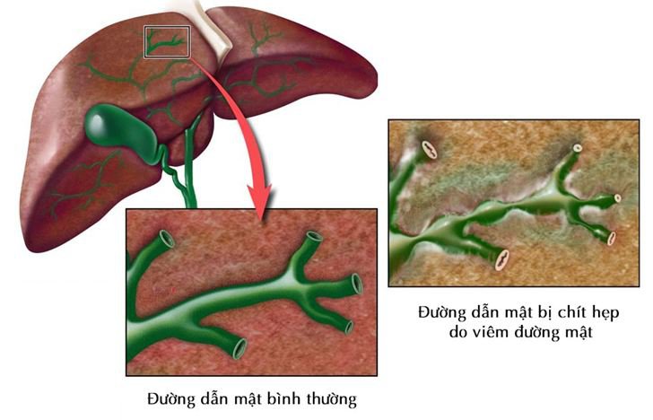 Hẹp đường mật
