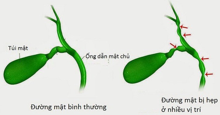 Chít hẹp đường mật