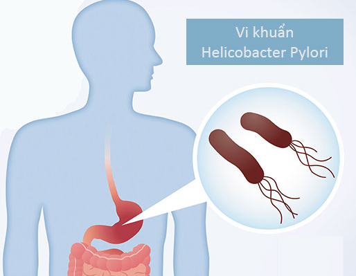 Vi khuẩn HP