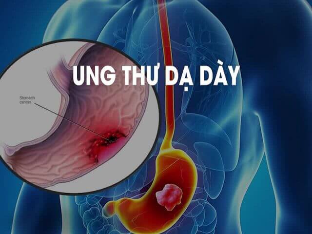 Khác biệt nổi trội khi điều trị ung thư dạ dày tại Bệnh viện Vinmec
