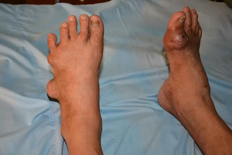 Bệnh gout là gì