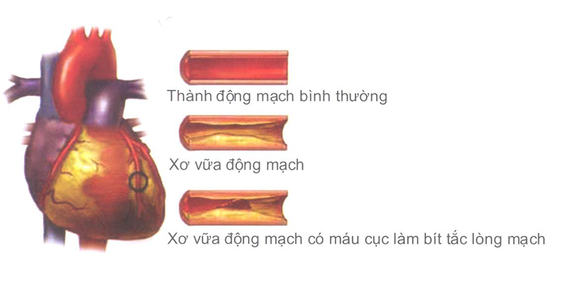 Xơ vữa động mạch Xơ vữa động mạch