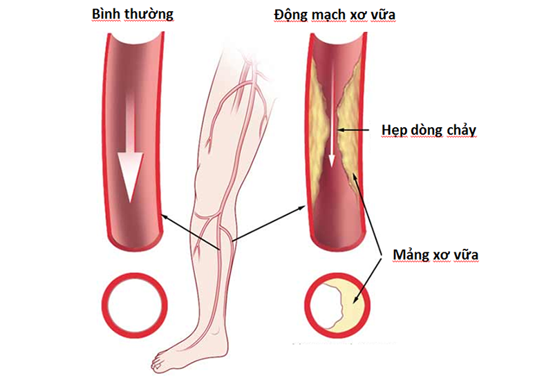 Bệnh động mạch ngoại biên là gì? Bệnh động mạch ngoại biên là gì?