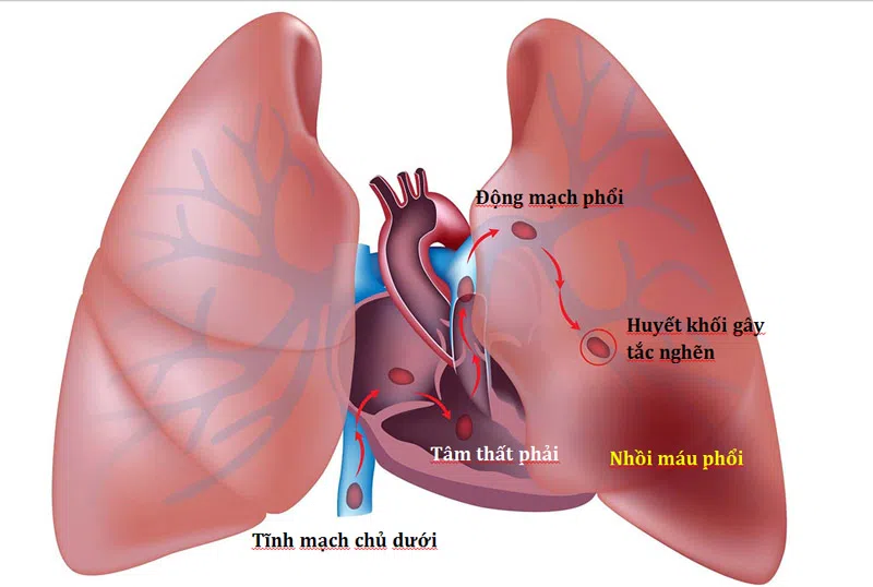 Bệnh Thuyên tắc phổi là gì?