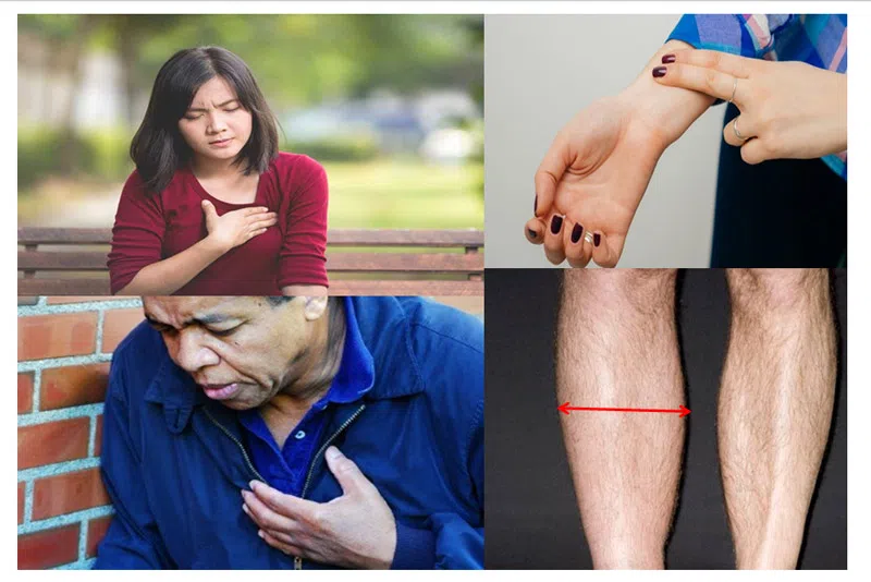 Triệu chứng bệnh Thuyên tắc phổi