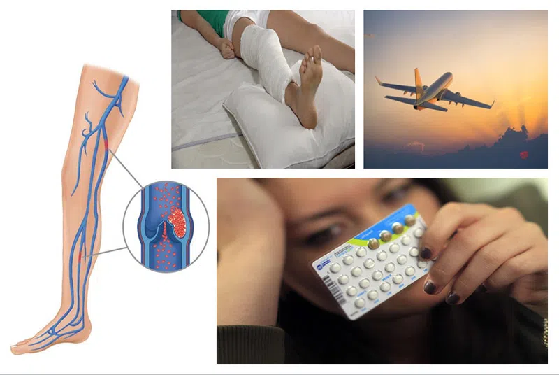 Nguyên nhân bệnh thuyên tắc phổi