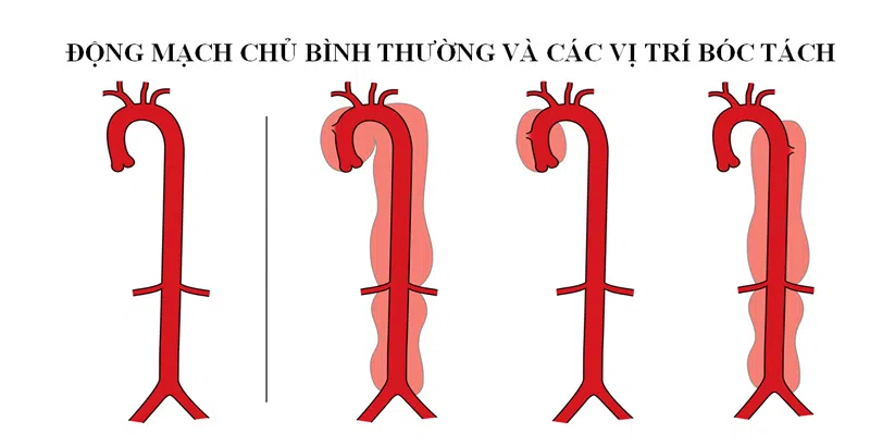 Bóc tách động mạch chủ là gì?