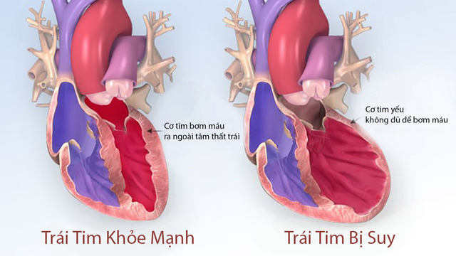 Suy tim là bệnh mạn tính, khó có thể chữa khỏi hoàn toàn và là biến chứng chung của tất cả <span style= Suy tim là bệnh mạn tính, khó có thể chữa khỏi hoàn toàn và là biến chứng chung của tất cả những bệnh tim mạch